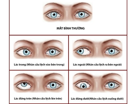 Cách chữa mắt lé nhẹ phương pháp nào hiệu quả?