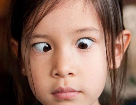 Cảnh báo hiện tượng bị lác mắt ở trẻ em ngày càng tăng cao. Khám chữa thì đã muộn